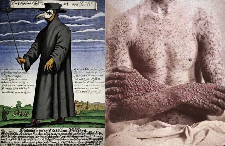 (Left) A Plague doctor and his typical apparel in seventeenth-century Rome; (right) A case of smallpox, 1886